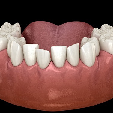 Illustration of crowded teeth