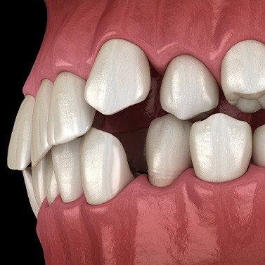 Illustration of gapped teeth