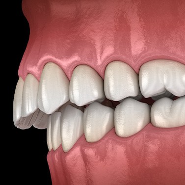 Illustration of an overbite