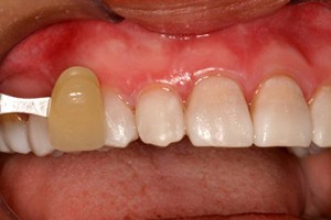 Smile compared to original tooth color after teeth whitening
