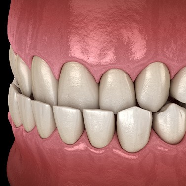 Illustration of an underbite