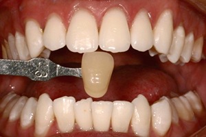 Smile compared to original yellow tooth color after teeth whitening