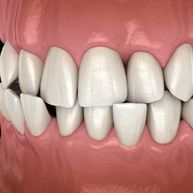 Illustration of a crossbite