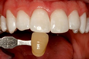 Smile compared to original dark tooth color after teeth whitening