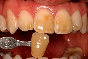 Darkly discolored teeth before teeth whitening