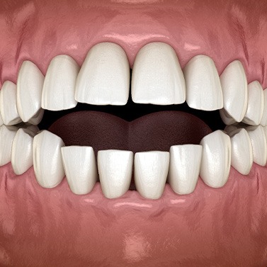 Illustration of an open bite