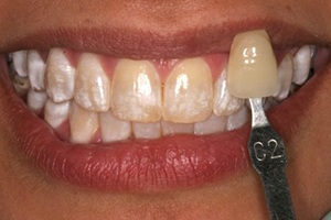 Smile with dental discoloration beofre teeth whitening