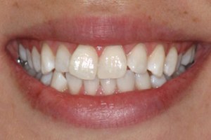Bright smile after professional teeth whitening