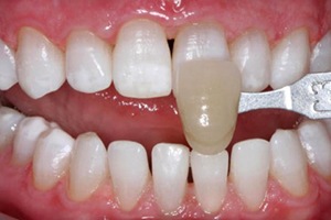 Smile compared to original discoloration after professional teeth whitening