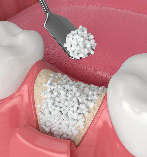 Illustration of bone grafting in West Palm Beach