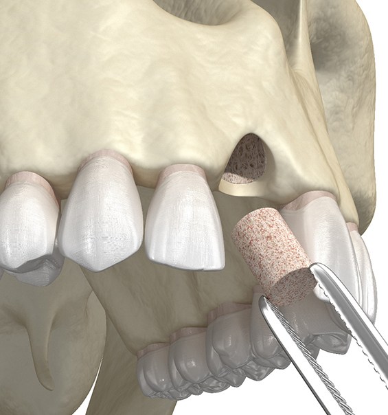 Illustration of bone grafting performed in upper jaw