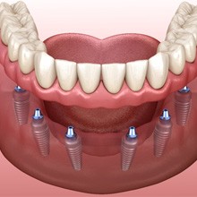 Illustration of implant dentures in West Palm Beach, FL