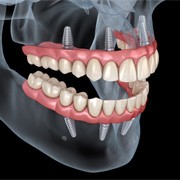 a digital illustration of teeth-in-a-day dentures in West Palm Beach