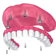 four dental implants securing a full denture on the upper arch