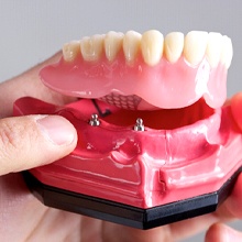 person holding a model of an implant denture