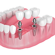 two dental implants supporting a dental bridge