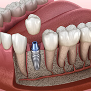 dental implant being placed in the lower jaw