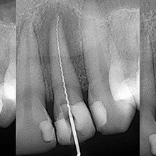 X-ray of root canal treated tooth