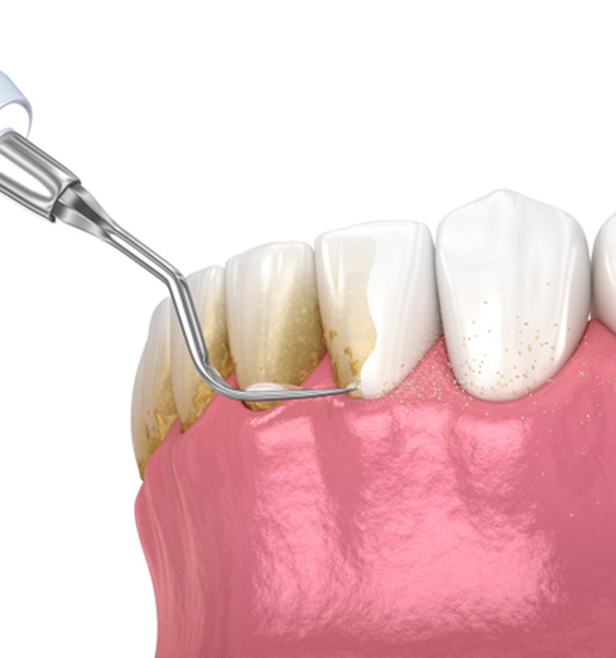 Scaling and root planing can help eliminate dangerous oral bacteria and treat gum disease