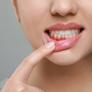 You may need scaling and root planing if you have symptoms of gum disease like red, swollen gums