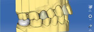 Digital design of a dental restoration