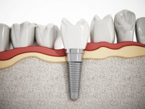 illustration of a dental implant