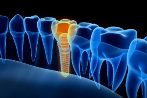 Computer graphic of a dental implant