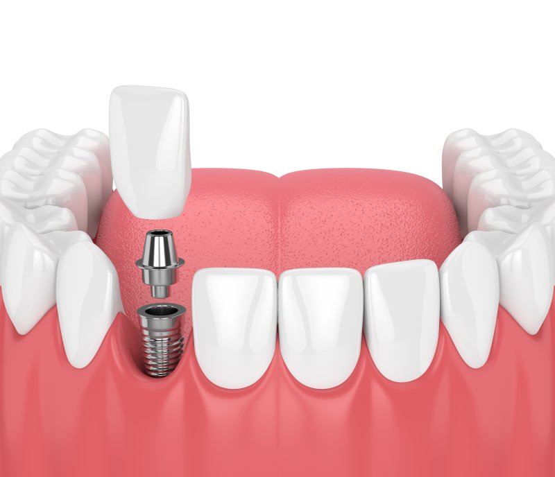 Dental Implant