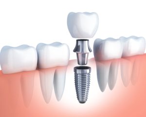 diagram of dental implant, abutment, and crown replacing bottom tooth 