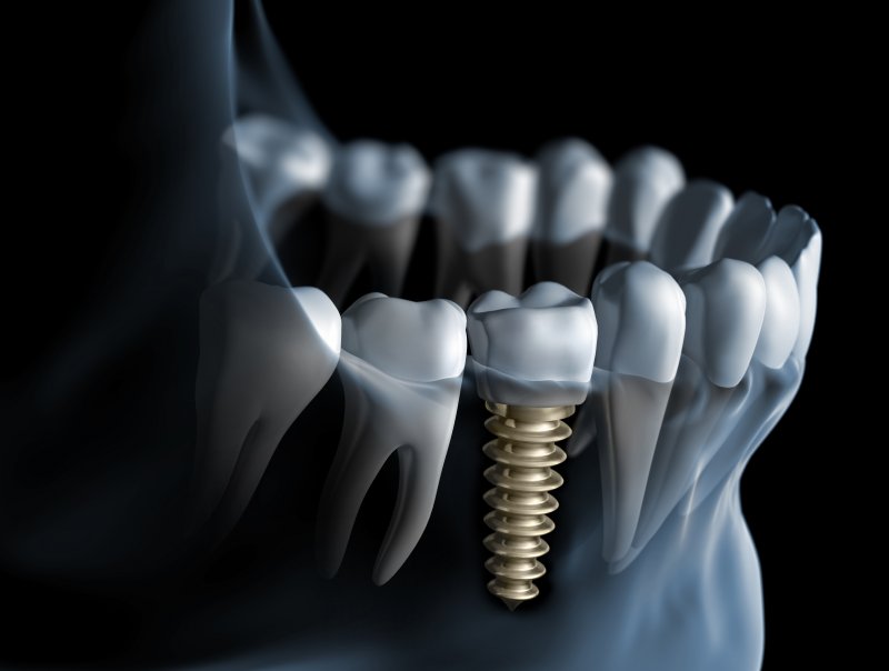 Dental implant in West Palm Beach