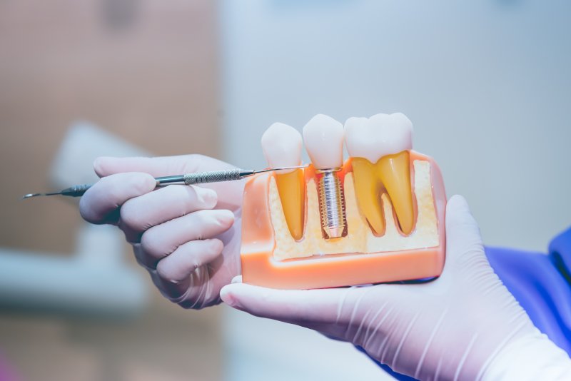 Dentist holding a model of dental implants