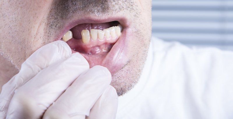 A close-up of a man with missing teeth