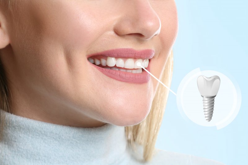 A woman smiling with her new dental implants