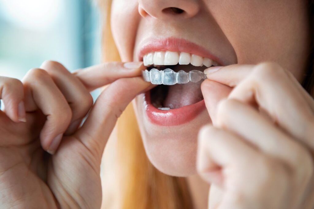 A woman removing a clear aligner