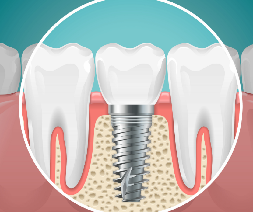 Illustrated cross section of a dental implant